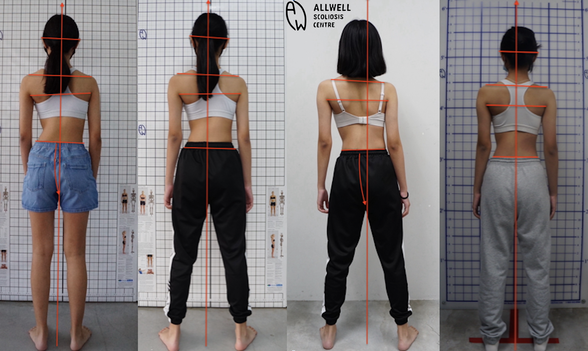 Understanding Scoliosis and Its Impact on Posture