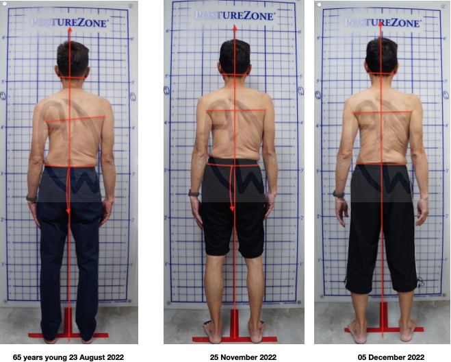 Understanding Lower Back pain and Scoliosis