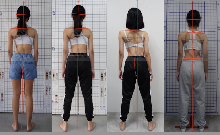 How to Fix Scoliosis Rotation with Core Activation and Breathing Techniques